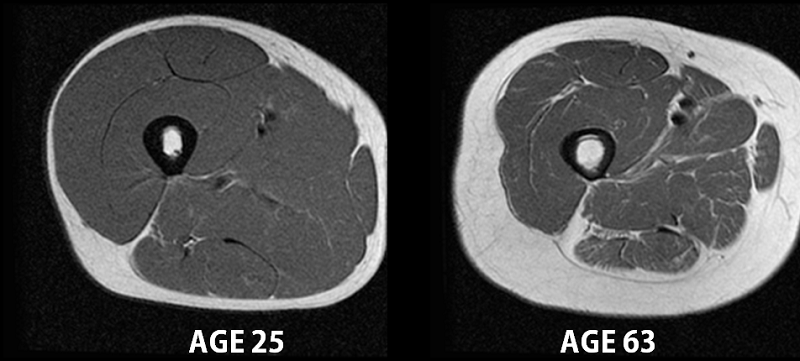 Comparaison d’une coupe de muscle à 25 ans et à 63 ans montrant la perte de masse musculaire liée à la sarcopénie